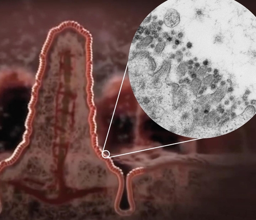 腸융모막의 전자현미경 사진[장 세포에 코로나19 바이러스(검은 점)들이 보인다]